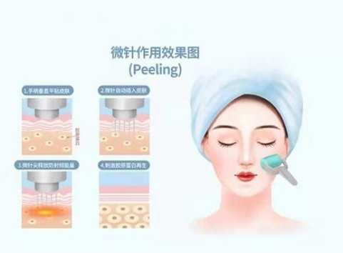 上海九院黄金微针价格表，不同疗程收费、适合人群和真实效果一次看懂