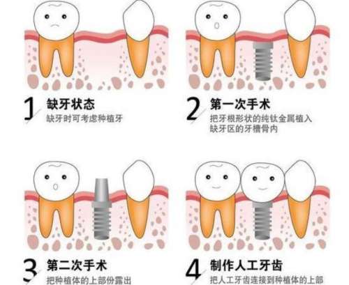 揭阳全口种植牙多少钱？价格明细参考！细节公布