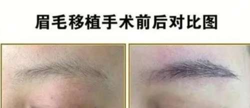 植眉毛一般价格要多少钱