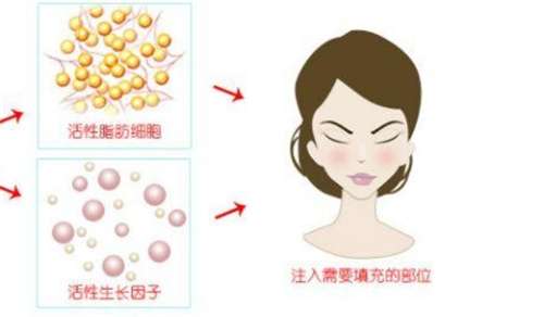 面部脂肪填充一般价格？面部脂肪填充费用