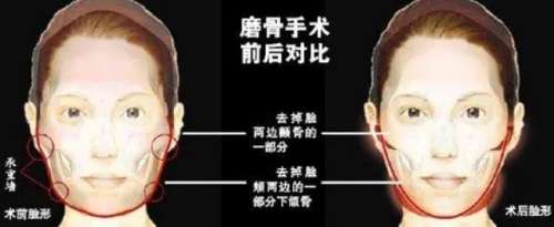 下颌角长曲线截骨术价格多少钱？有哪些因素影响