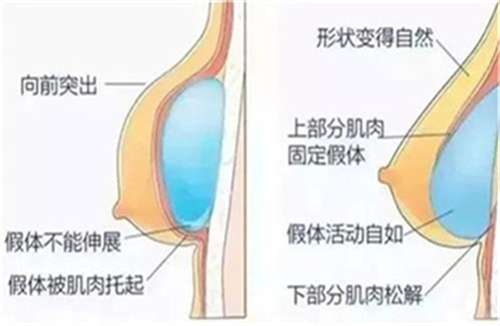 麦格假体丰胸的价格？多久可以随意按摩？较多科普解答