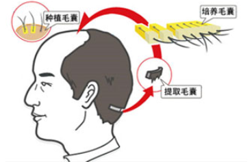 佛山发际线种植后需要多久恢复？当地正规植发医院承诺
