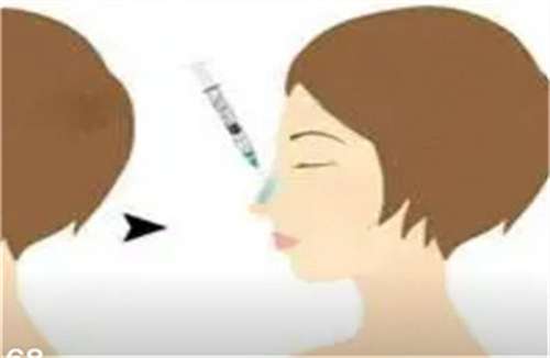假体隆鼻手术大概多少钱？能维持一辈子吗？点击看答案