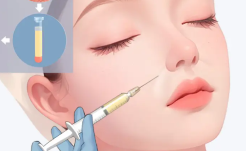 徐海倩做脂肪填充一次能成型吗｜方案设计、术后变化和效果稳定性分析