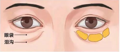 郑州祛眼袋哪家强？微创/切开/激光方案全梳理，附真实反馈