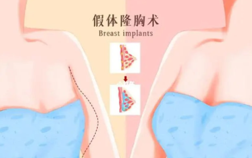 深圳隆胸价格大概在多少？脂肪丰胸哪家医院好？