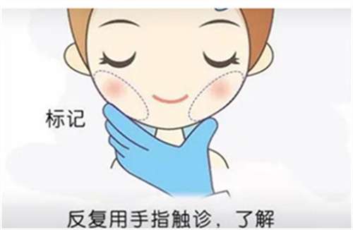 面部吸脂价格怎么样？吸脂后还会反弹吗？