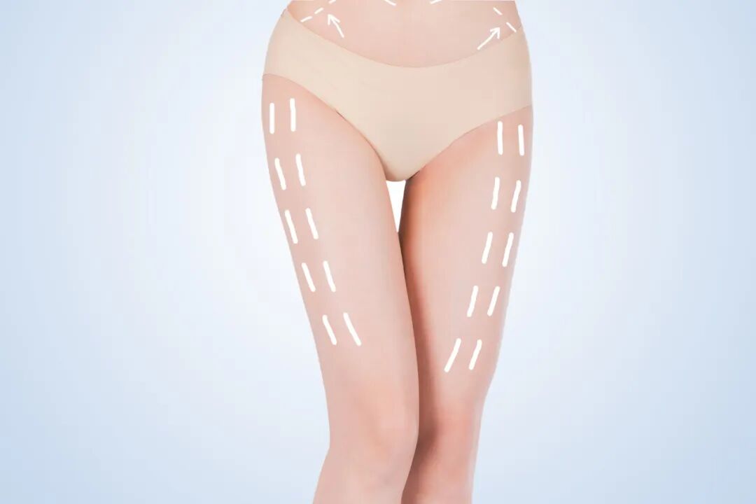 北京大腿吸脂价格需要多少钱？北京专业大腿吸脂医院