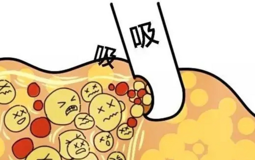 协和医院吸脂挂什么科？新手就诊科室选择解答