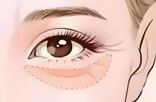 宝鸡去眼袋多少钱一次？本地姐妹必看的价格清单+避坑指南