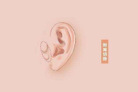 临沂耳部附耳切除疤痕明显吗?三甲医院整形科小耳畸形矫正经验
