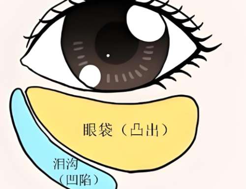 温州去眼袋价格是多少？受哪些因素影响这里看