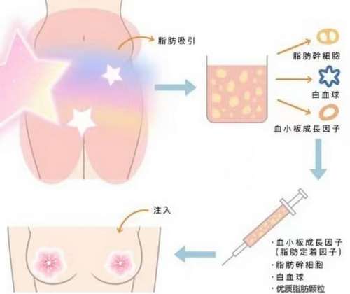 2026北京自体脂肪丰胸医生排名口碑实力双在线！技术审美PK