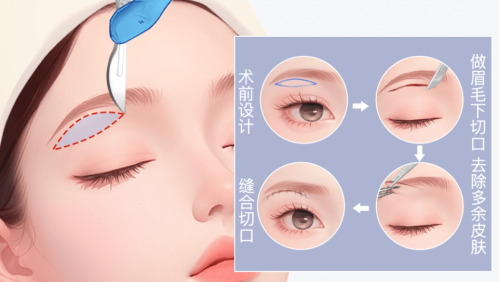 宁波华美医院整形科做提眉好吗？适合人群、手术方式和恢复周期解答