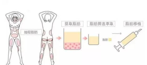 哈尔滨医大一院打水光针多少钱？1000元起，本土热门医院与真假辨别指南