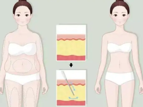 重庆大坪医院有吸脂手术吗？项目类型、术前评估与术后管理一文掌握