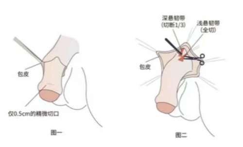 延长增粗手术和需要多少钱？手术与联合项目价格一览