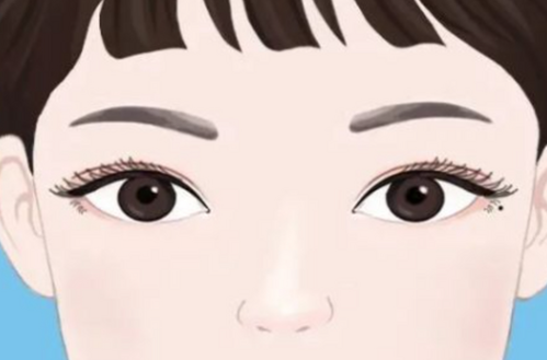 耿传卫的双眼皮手术案例｜术前基础、术后线条和恢复反馈一次看清