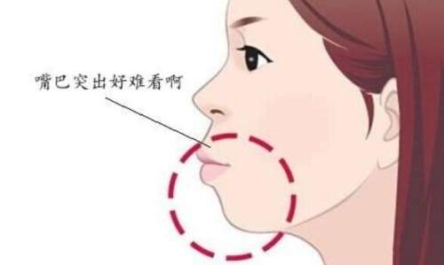 广州做下巴后缩手术大概多少钱？推荐几家口碑好又实惠的医院！