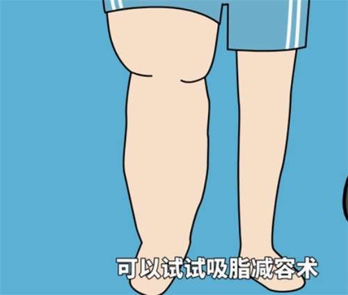 小腿吸脂费用高吗？吸脂价格表2026公布