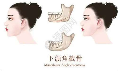 下颌角磨骨费用多少钱？进入看详情介绍
