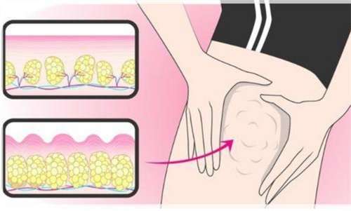 大腿吸脂参考价格是多少？吸脂收费贵吗？