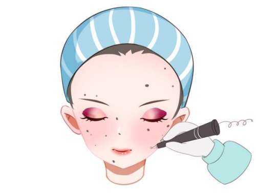 激光点痦子多少钱一个
