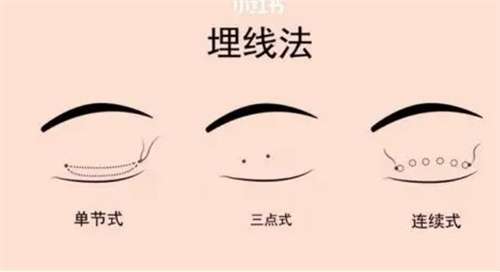 徐州埋线双眼皮需要多少钱？探讨美容整形实惠方案分析