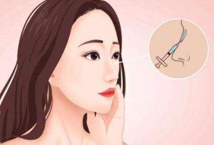 泸州玻尿酸隆鼻多少钱