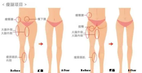 昆明吸脂医院哪里好？本地热门机构医生投诉率与满意度调查
