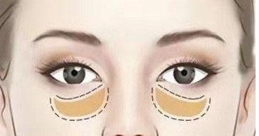 济南眼袋手术正规医院哪家好？公立三甲与私立机构对比推荐