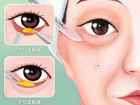 阜阳做眼袋手术价格多少？3个核心因素赶紧看！