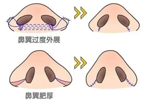鼻翼缩小手术多少钱