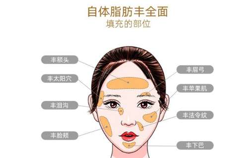 自体脂肪丰太阳凹陷多少钱？术后多久自然