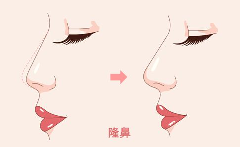 益阳玻尿酸隆鼻一般多少钱