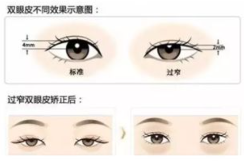 江门做双眼皮医院排名！选全切还是埋线？