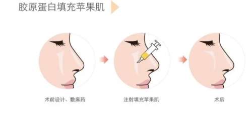 胶原蛋白填充脸部多少钱？大概在5000~12,000元不等
