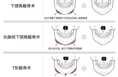下巴太长截骨手术多少钱