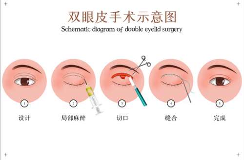 长春全切双眼皮修复多少钱？这3家综合实力强