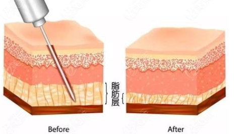 南京吸脂医院哪里好？医院等级、麻醉方式及医生术后护理对比