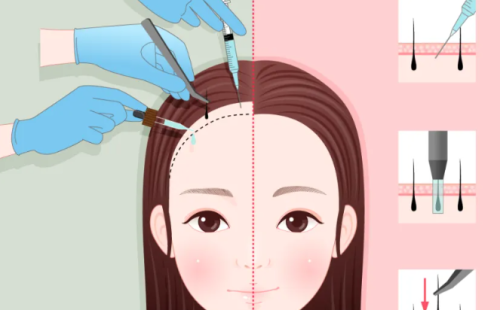 弋矶山医院植发效果怎么样？脱发人群术前要看的关键点