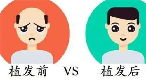秃顶种植价格贵吗？在线看2026年费用