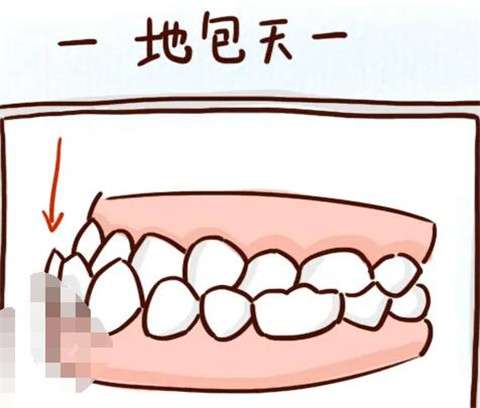 地包天要怎么矫正？一般要花多少钱？