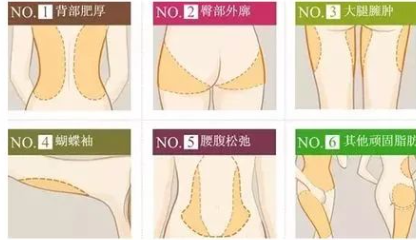 天津吸脂去哪做？医大总医院、市人民医院，吸脂术后平整度与恢复期全知道！