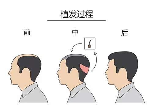 发际线植发多少钱一次？价格咨询点击了解