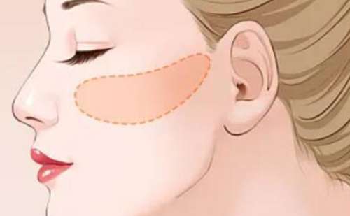 南京医科大学第二附属医院沈干微创颧骨整形多少钱?技术测评+术后120天案例