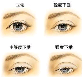 武汉陈平做双眼皮修复怎么样？ 同济坐诊，附案例+收费价格表详解
