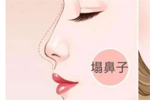 鼻部假体取出要多少钱？费用在线讲解，信息出炉