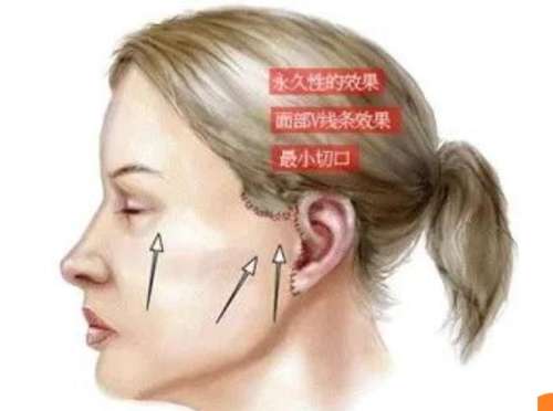 小切口面部提升手术价格，参考价格是2w-10w元左右